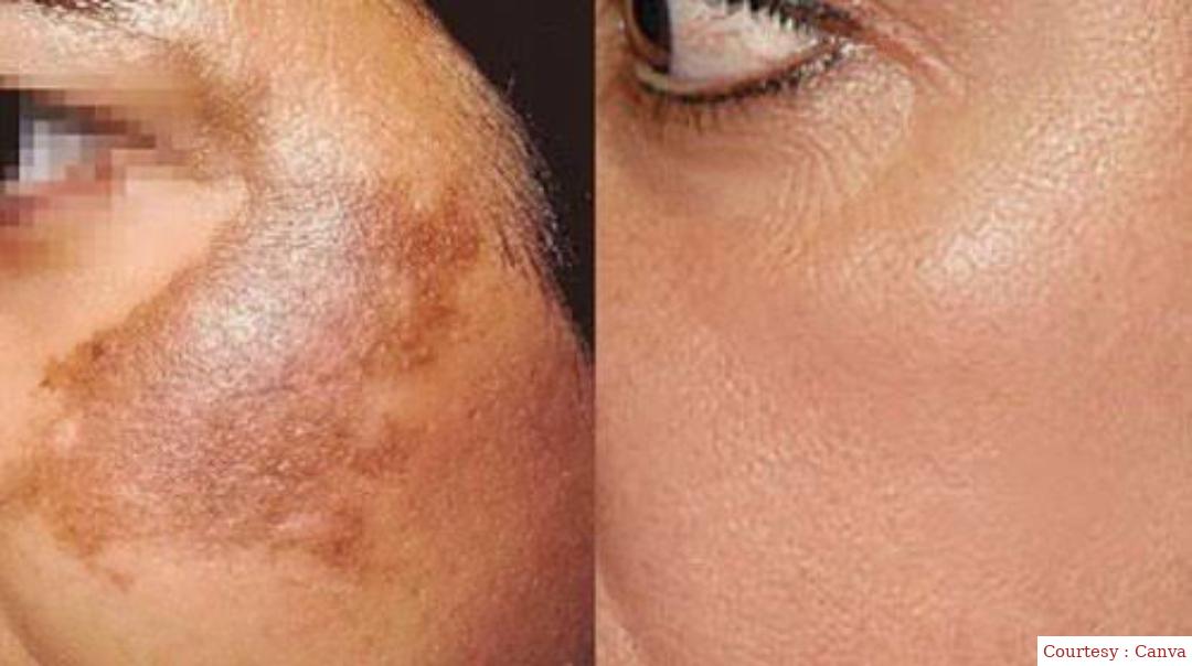 Are you also upset with the pigmentation? This is how facial problem will miss