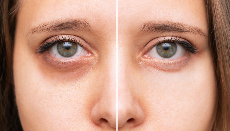 Dark circles will be disturbed, try these home remedies