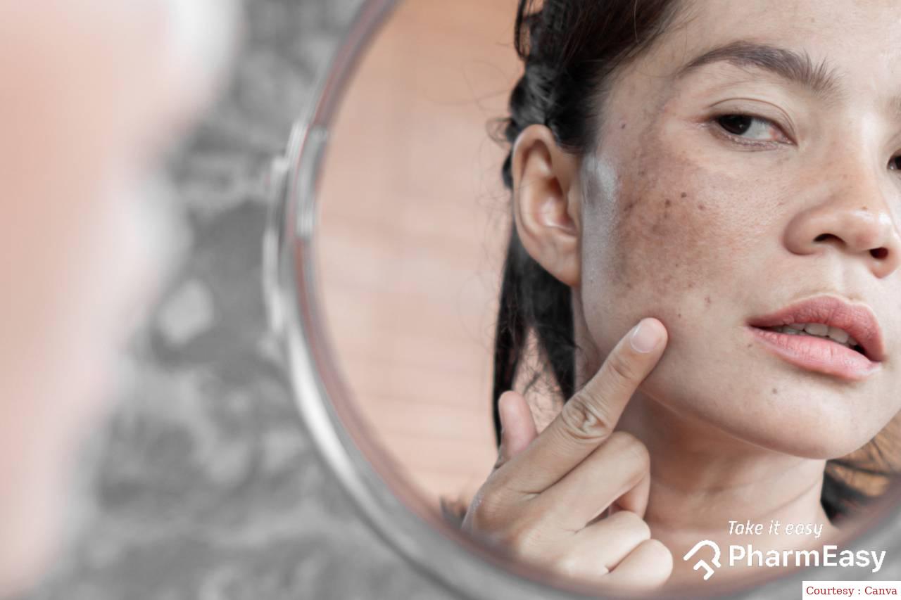 Domestic way to remove black spots on face