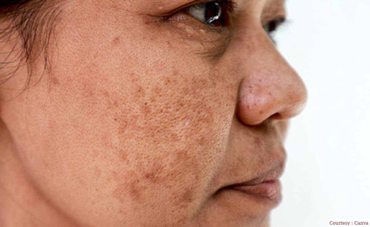 Get rid of freckles in just 7 days