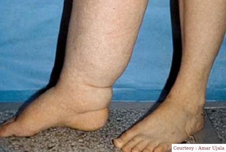 फाइलेरिया रोग को लेकर मोदी सरकार सख्त ।