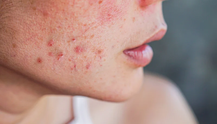 Home remedies to remove acne