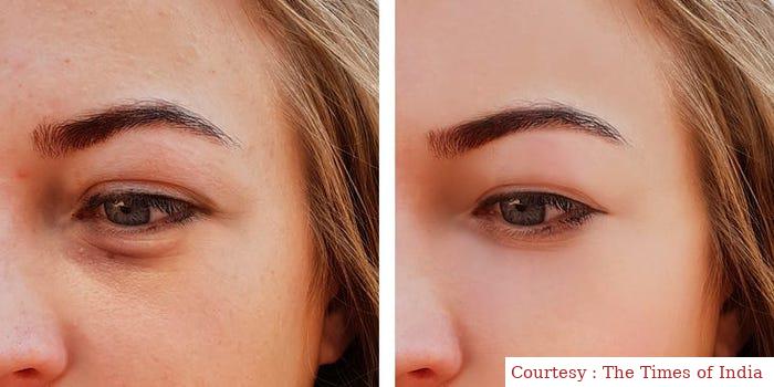 चेहरे की पफिनेस को कम करे आइस फेशियल