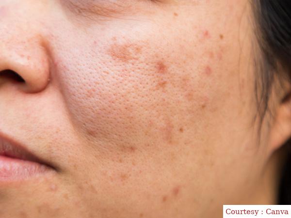 If you are disturbed by facial stains, then apply this face pack