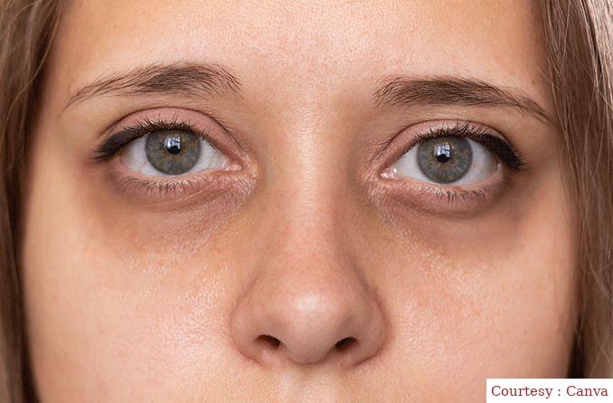 Troubled by dark circle, try this eye mask