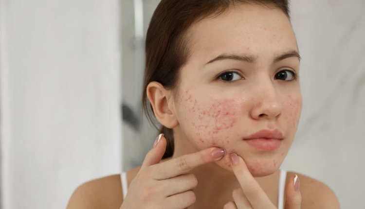 These home remedies remove the problem of pimples