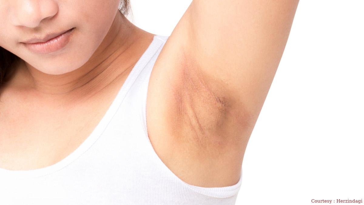 Try these tips to free the blackness of the underarm