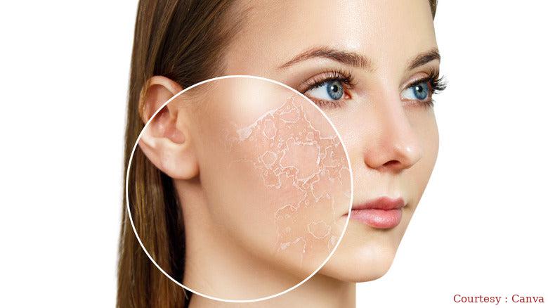 Use this home recipe in winter season