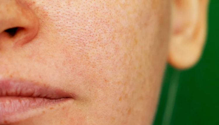 Want to get rid of the skin on the skin, follow these beauty tips